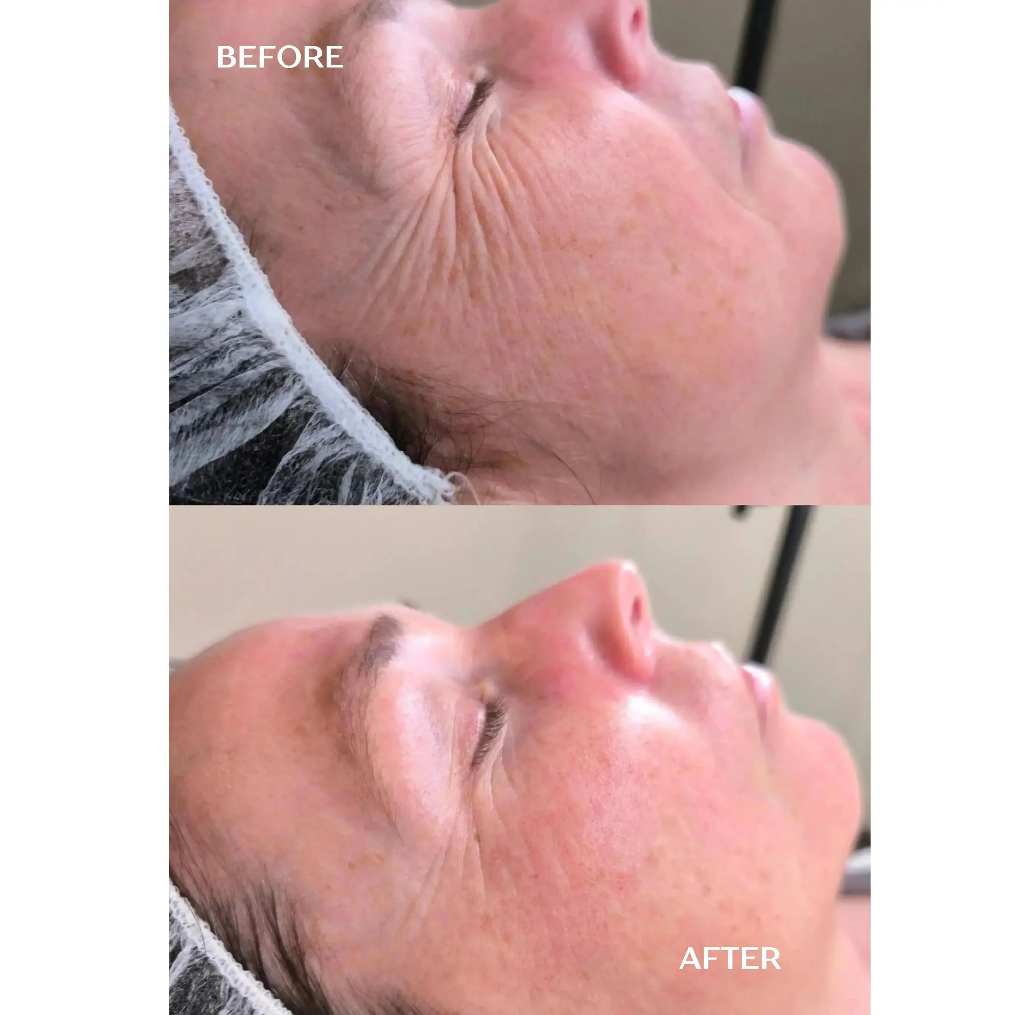 Renewal Infusion | 1 applicatie - Sint-Katelijne-Waver